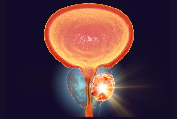 Prostate Care
